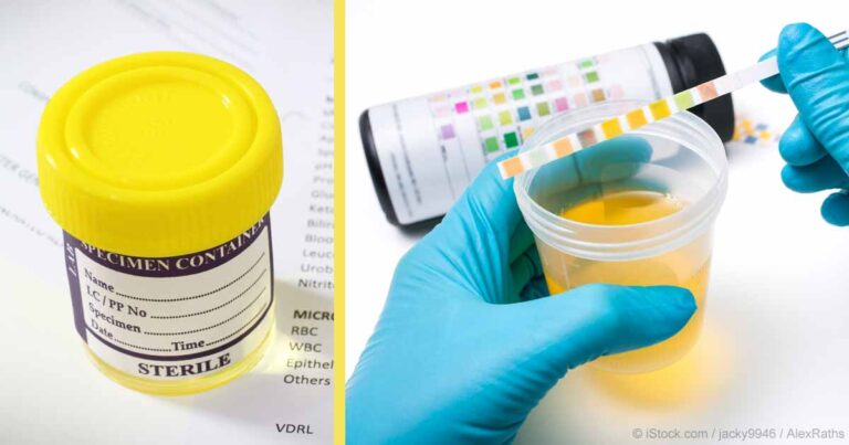 Studimi i fundit: Testi i urinës për zbulimin e kancerit ovarian në fazat e hershme