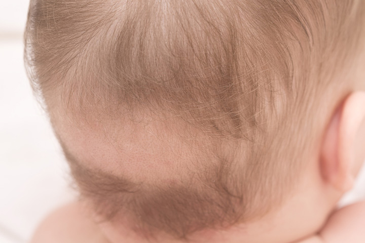 Выпадают волосы 4 месяц. Гнёздная очаговая алопеция у детей. Залысина на голове у ребенка.