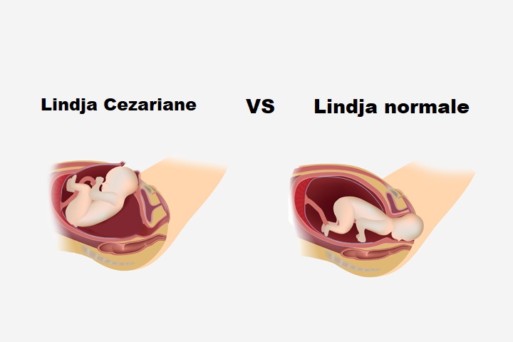 Parto normale vs. parto cesareo: vantaggi e rischi