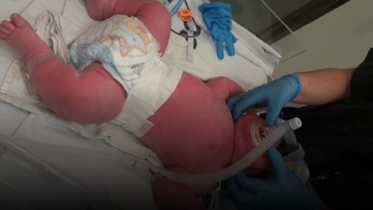 Foshnja që lindi me peshë 7.39 kg, operacioni zgjati mbi tre orë