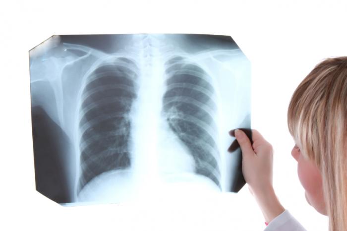 Tuberkulozi: Simptomat, trajtimi dhe parandalimi