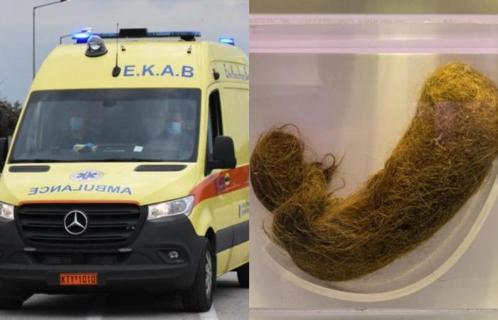 E rrallë në Selanik, 14-vjeçares i hiqen nga stomaku 700 gramë flokë Sindroma Rapunzel ne Selanik