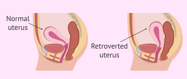 Mitra e retrovertuar: Shkaqet, simptomat, diagnoza, trajtimi dhe pasojat