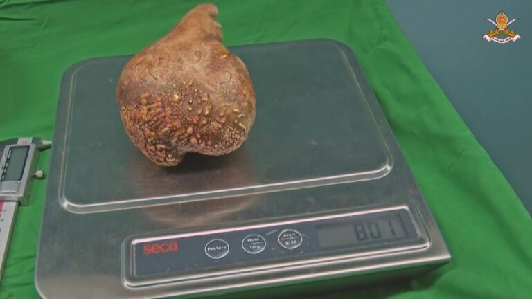 Video: Mjekët e Sri Lankës heqin “gurin më të madh nga veshka në botë” Guri me i madh i veshkave