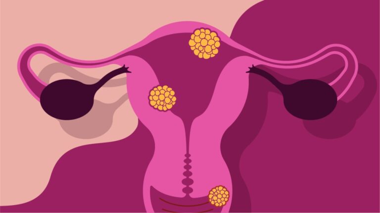 Si të mbroheni nga vaginoza bakteriale?