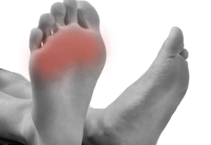Metatarsalgia: Shkaqet, simptomat dhe trajtimi