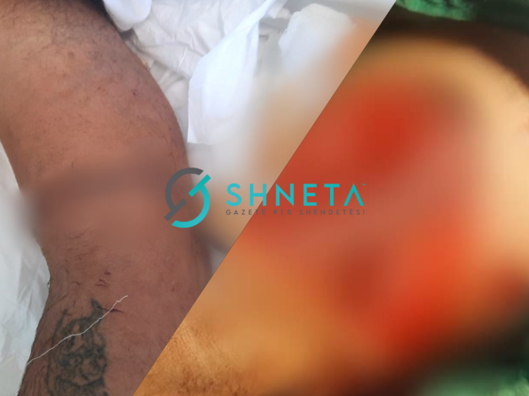 Emrat e mjekëve të cilët e realizuan operacionin e rrallë në QKUK për ngjitjen e krahut të prerë tek pacienti