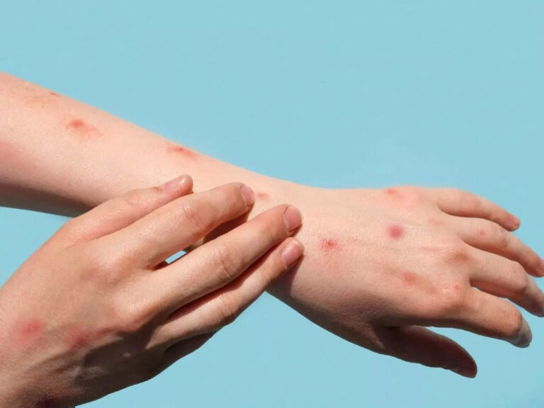Numrat e infeksionit Mpox tashmë janë pothuajse dyfishi i rasteve të vitit të kaluar në SHBA