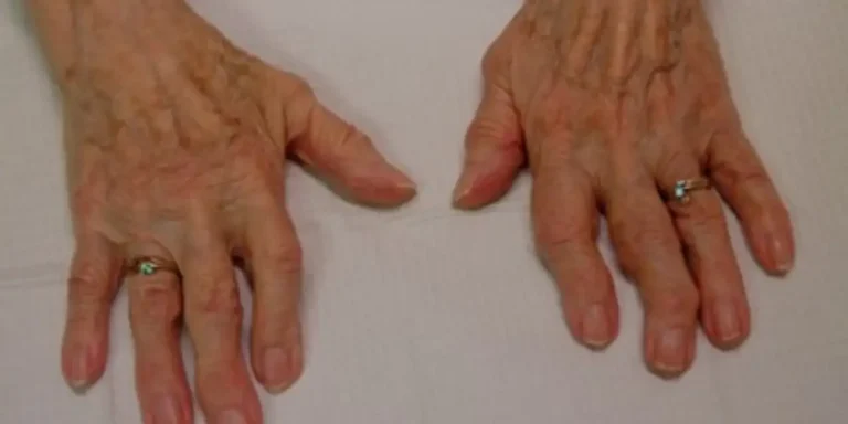 Osteoartriti rritë rrezikun e kushteve të tjera kronike shëndetësore