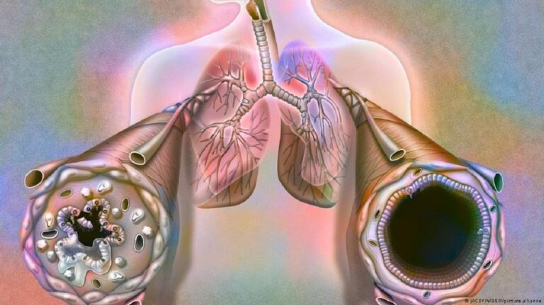 COPD-ja mund të rritet mes cilësisë së dobët të ajrit: Mjeku thekson ndërhyrjen dhe mbështetjen në kohë