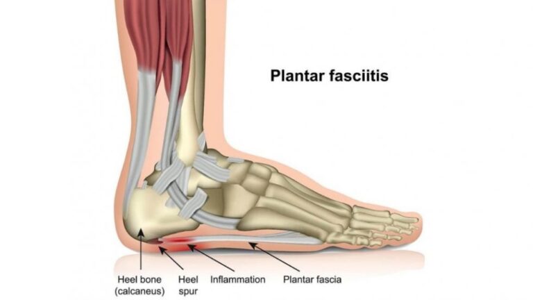 Kuptimi i fasciopatisë plantare, faktorët e rrezikut, diagnoza dhe menaxhimi