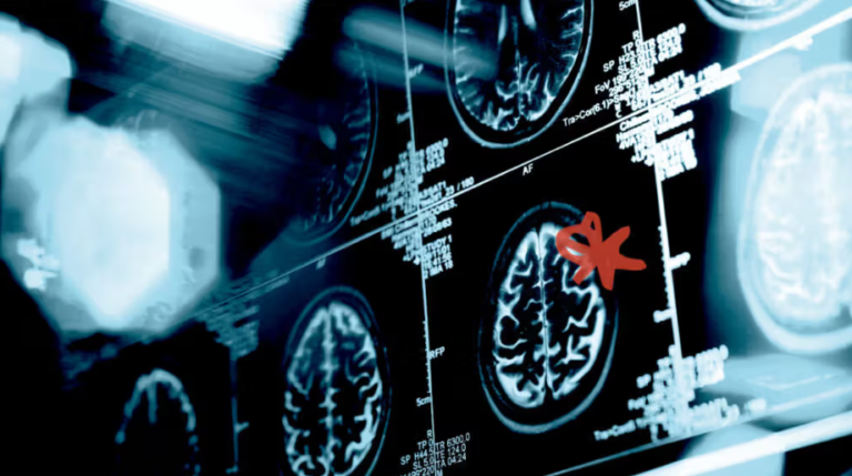 Si mund të ndihmojë inteligjenca artificiale në diagnostikimin e fëmijëve me ADHD