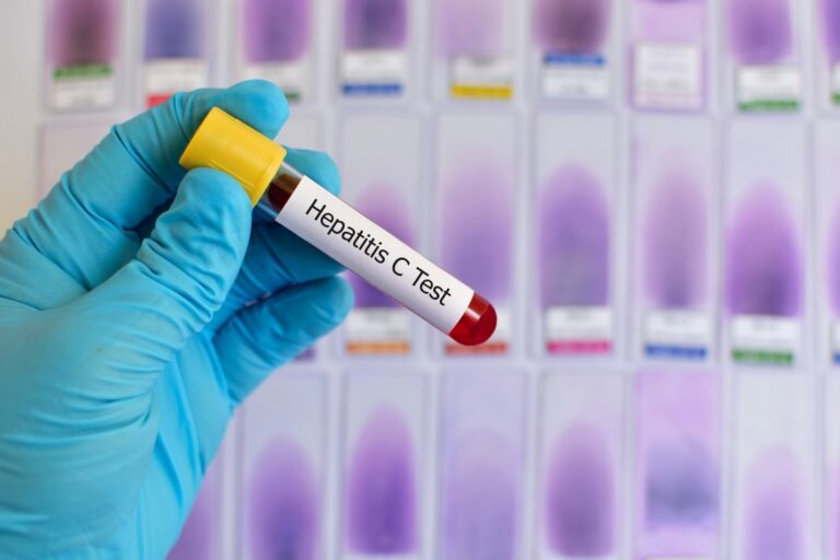 OBSH: Hepatiti vret 3.500 njerëz në ditë