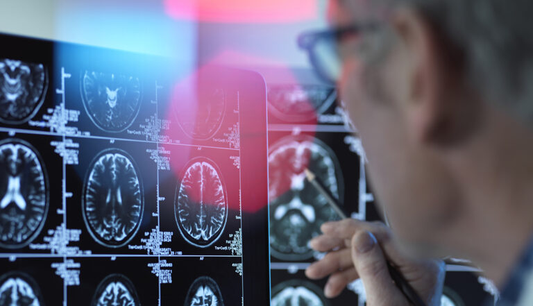 Cili është ndryshimi midis Alzheimerit dhe demencës