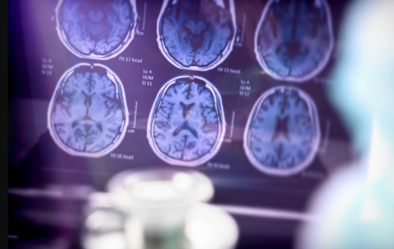 Shkencëtarët thonë se kanë identifikuar një formë të re gjenetike të sëmundjes së Alzheimerit