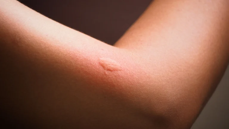 Dermatologu ndan këshilla thelbësore se si të mbroni lëkurën e fëmijës tuaj nga pickimi i insekteve, gërvishtjet dhe djegiet nga dielli