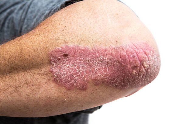Studim: Psoriaza lidhet me probleme të caktuara të gjumit