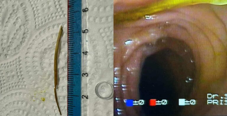 48-vjeçarit i ngeci hala e peshkut në zorrën e trashë, gastroenterologu Telaku ia largon me forceps