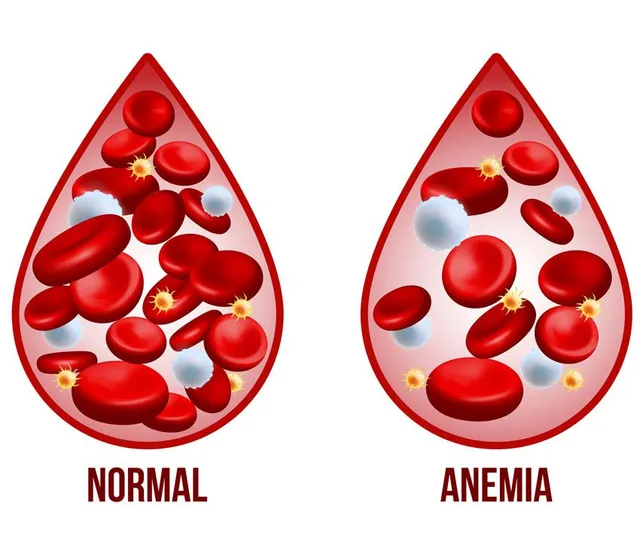 Çfarë është anemia dhe si funksionon në trupin e njeriut