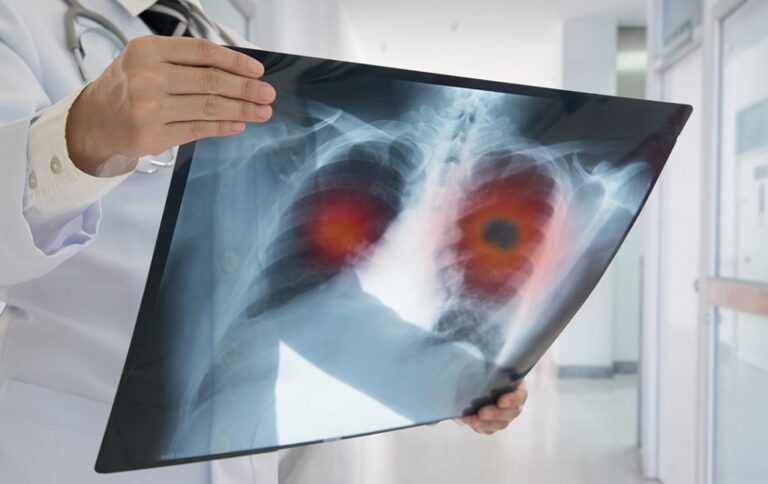 Testi i frymëmarrjes me ndihmën e AI-së mund të shpejtojë diagnostikimin e COPD-së
