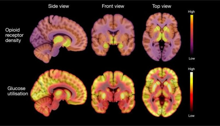 Pacientët me anoreksi kanë aktivitet të rritur të neurotransmetuesve opioidë në tru, tregon studimi