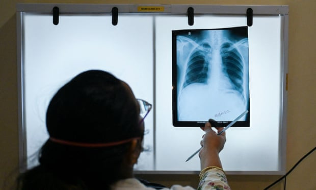 Pse tuberkulozi, sëmundja më infektive në botë, po rritet në Mbretërinë e Bashkuar?
