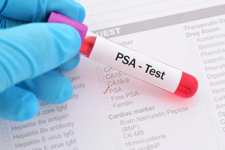 Testi i ri i pështymës më i mirë se testi i gjakut në zbulimin e kancerit të prostatës