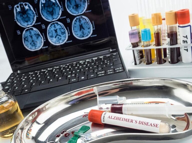 Studimi: Ilaqi Lecanemab mund të përdoret sigurt për pacientët me Alzheimer