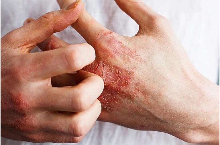 FDA miraton kremin e parë për trajtimin e ekzemës kronike të duarve