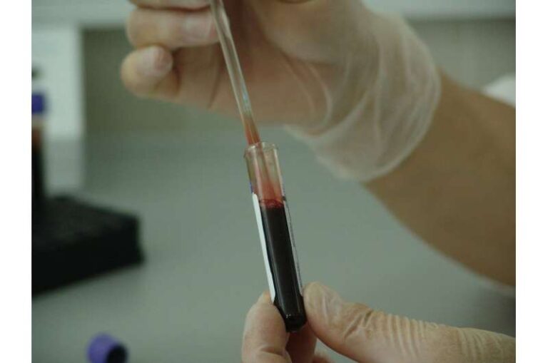 Testimi i biomarkerit PSA ul vdekshmërinë nga kanceri i prostatës