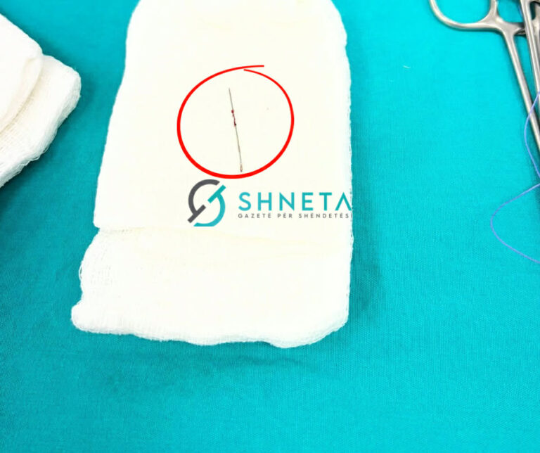 Mjekët e Klinikës së Kirurgjisë Torakale shpëtojnë 14-vjeçaren nga një rrezik i pazakontë dhe kërcënues për jetën